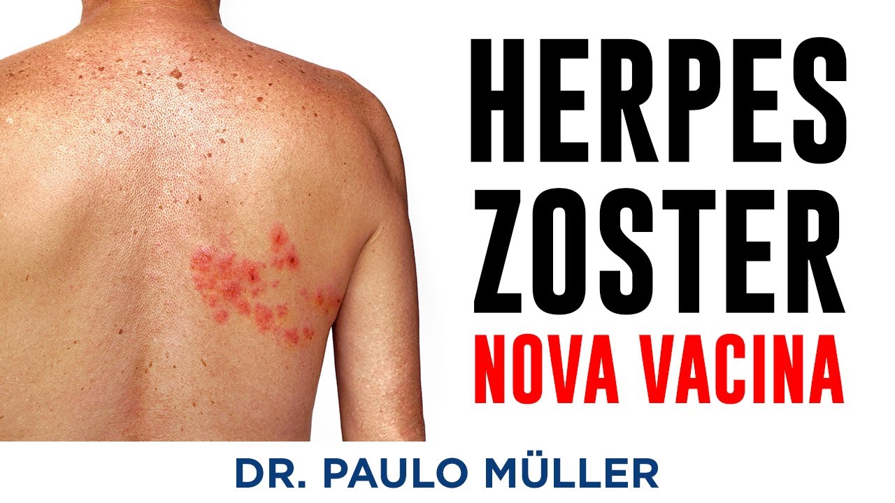 Nova Vacina para Herpes Zoster (Shingrix) – Dr. Paulo Müller Dermatologista.