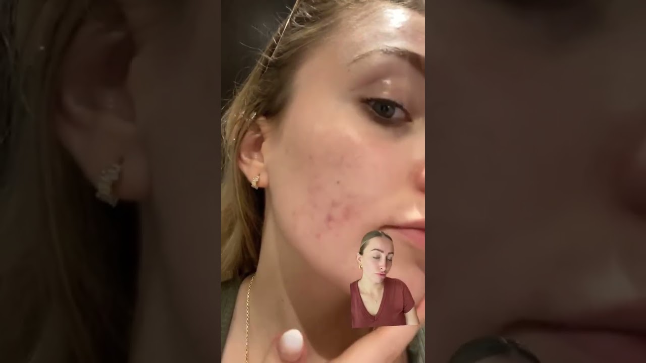 Anti-acne scars & anti-blemishes magic tool for the skin! ✨