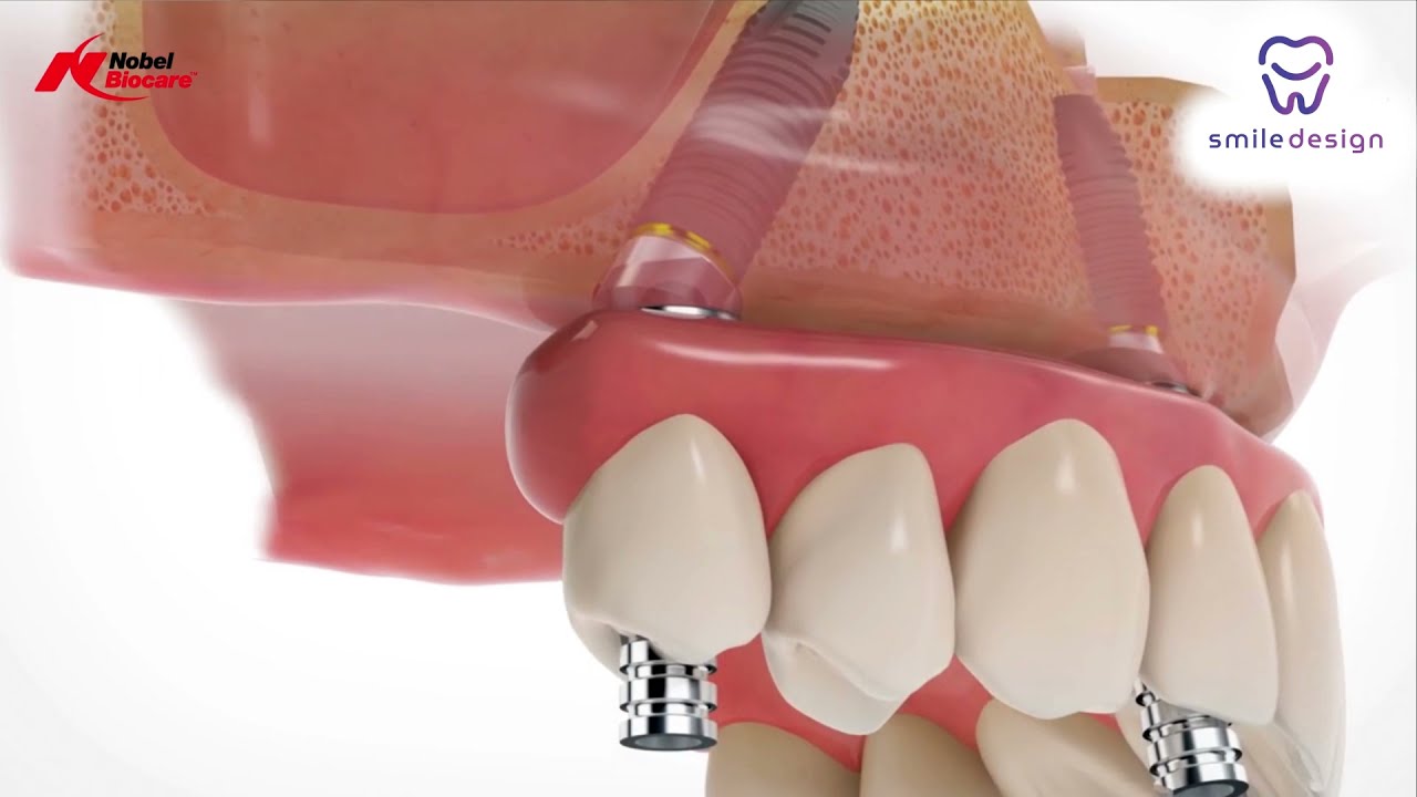 Pr&oacute;tesis Dentales Fijas All On 4 Implantes Dentales