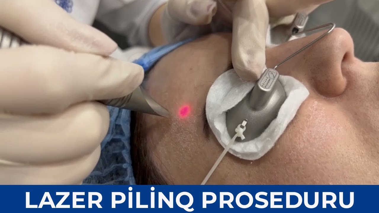 Lazer Pilinq Proseduru - Aynur Bədəvi - ( Dermatoveneroloq - kosmetoloq )