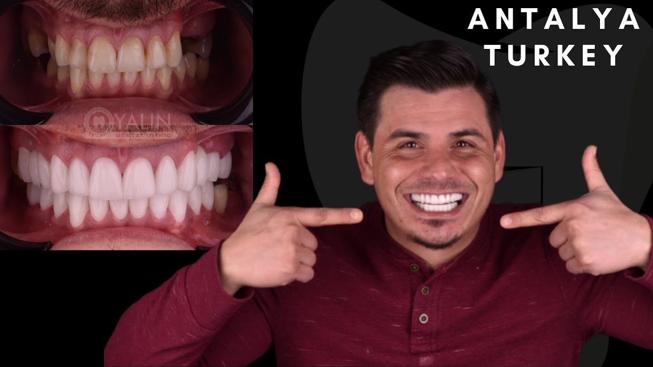 Best Dental Clinic Antalya - Turkey - Best Prices - Best Technology and Best Smile Makeover / Turkey