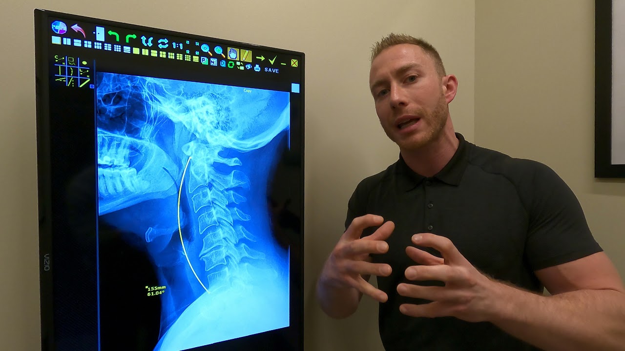 Importance of Spinal X-Rays