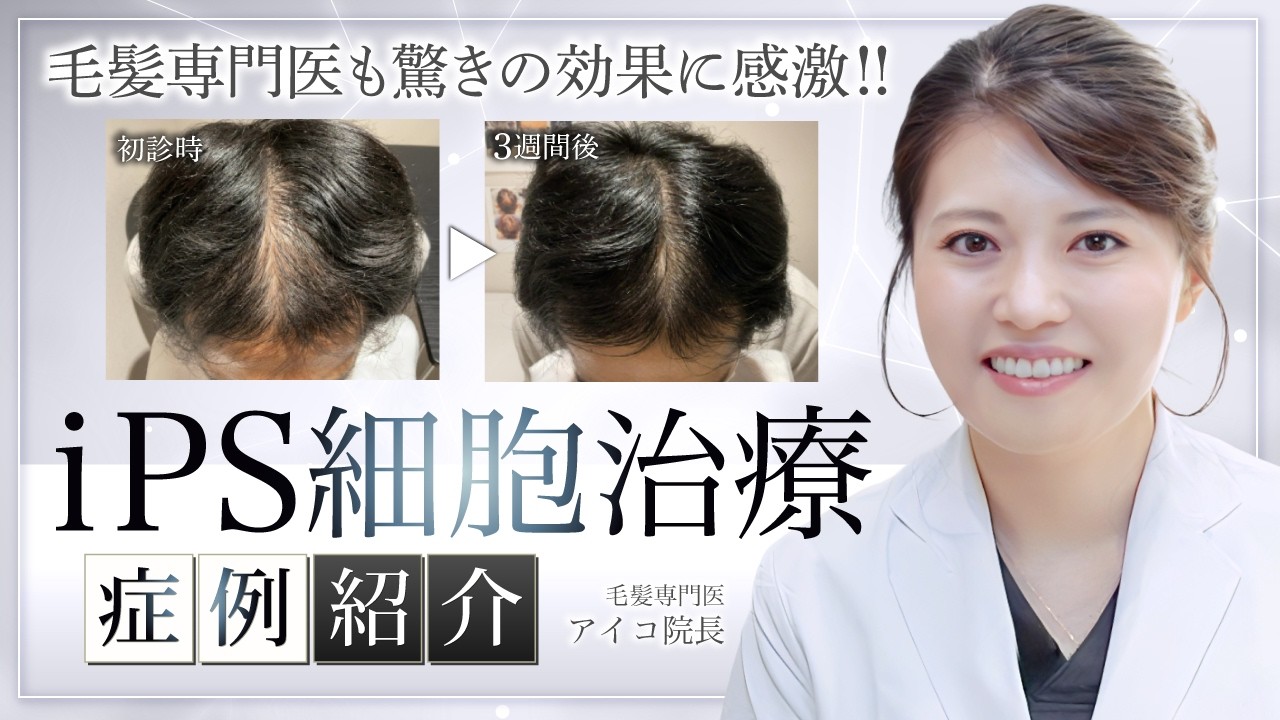 【たった1回で激変】再生医療iPS細胞治療でAGAが劇的改善【症例紹介】