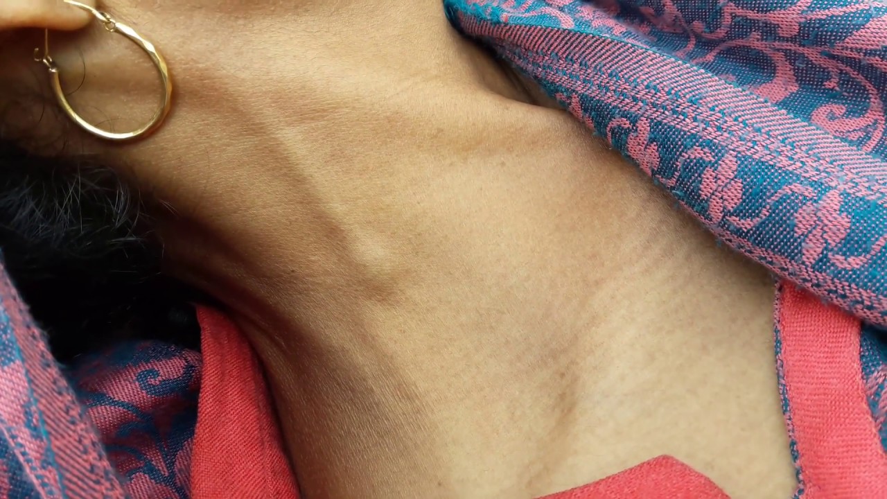 Jugular Vein Distension || Distended Veins || Raised JVP