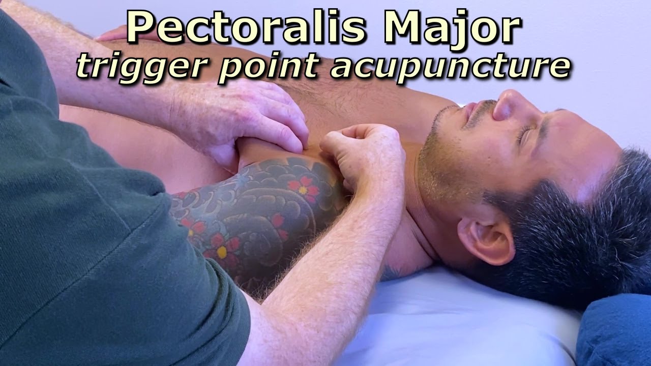 Pectoralis Major - Trigger Point Acupuncture