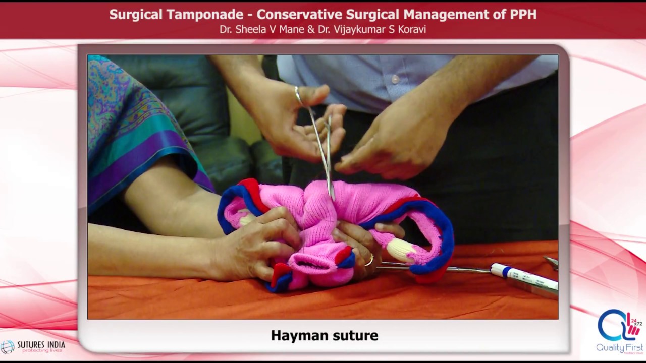Surgical Management of PPH by Dr. Sheela Mane