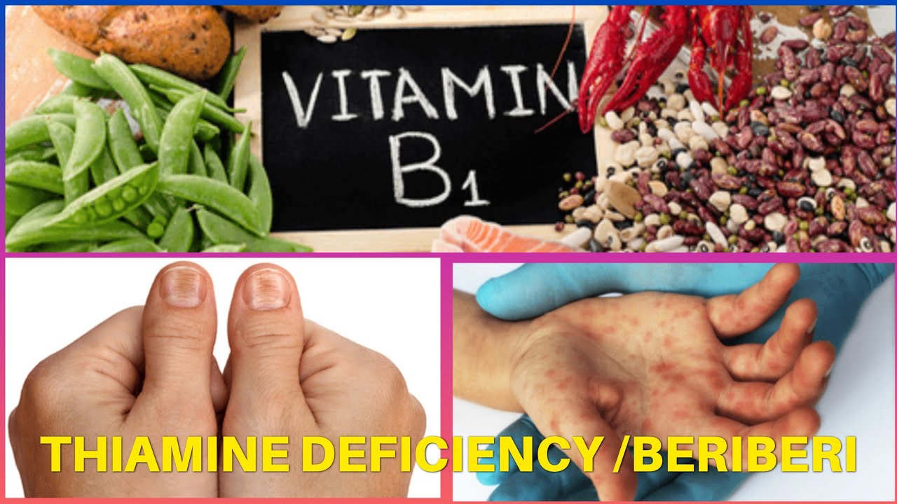 BeriBeri || Thiamine deficiency