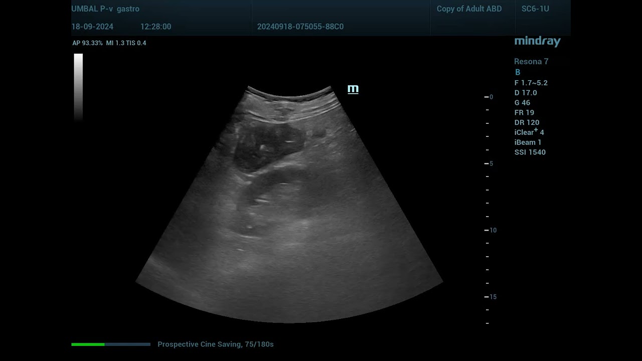 Pseudomembranous colitis