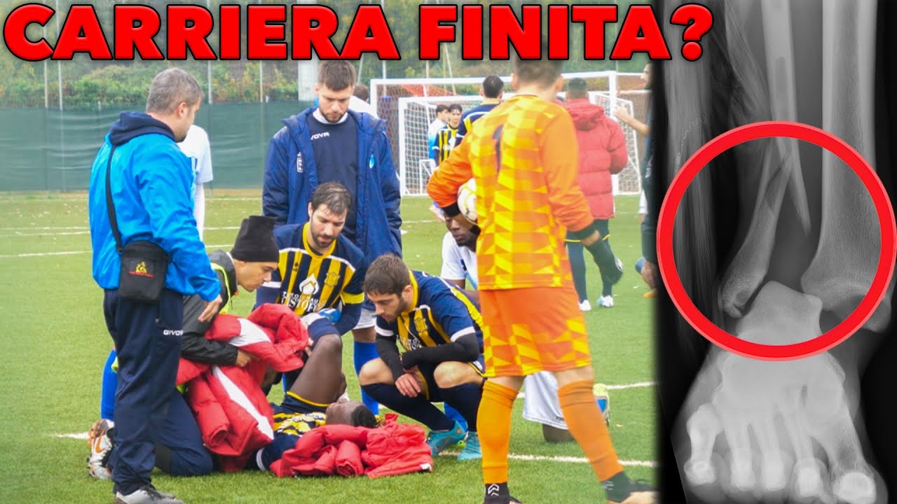 POTR&Oacute; GIOCARE ANCORA A CALCIO? L&rsquo;infortunio peggiore della mia vita 🚑