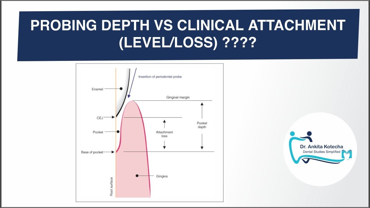 PROBING DEPTH versus CLINICAL ATTACHMENT LEVEL or LOSS (CAL)/ HOW TO MEASURE/DR. ANKITA KOTECHA