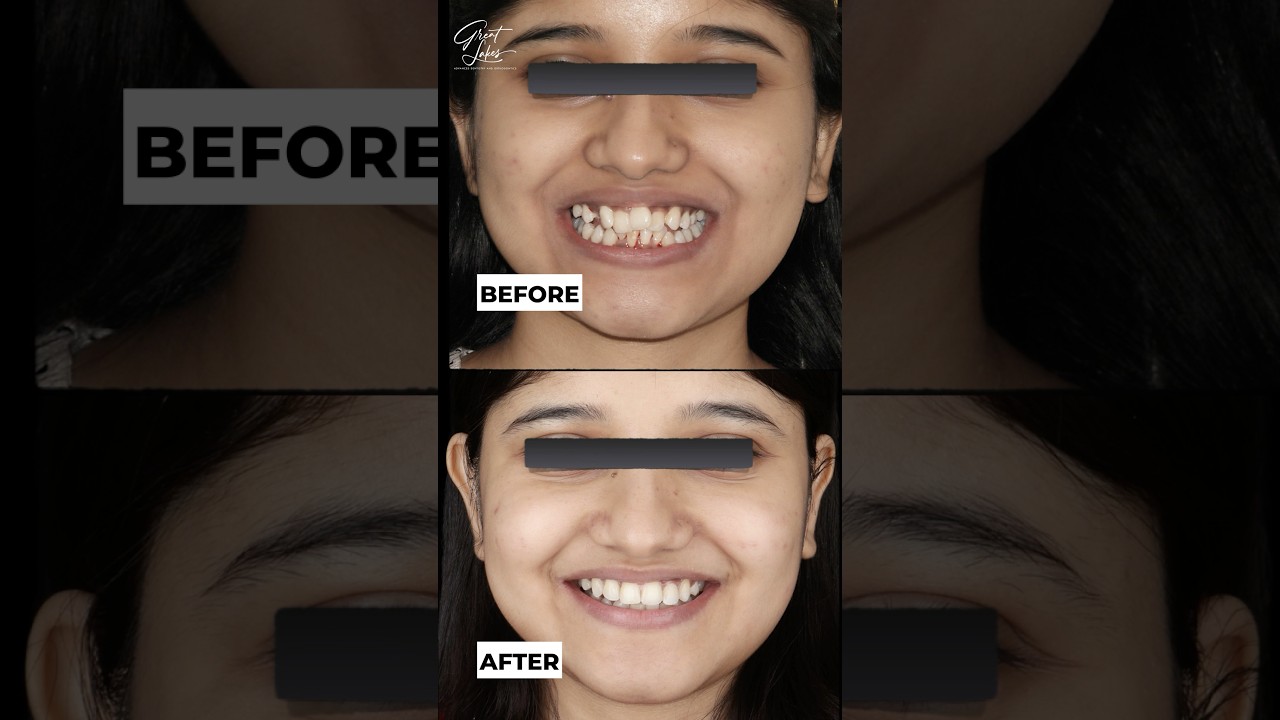 Before and After | Dental Braces | Clear Aligner - #dentistry #dentist #braces #invisalign #spark