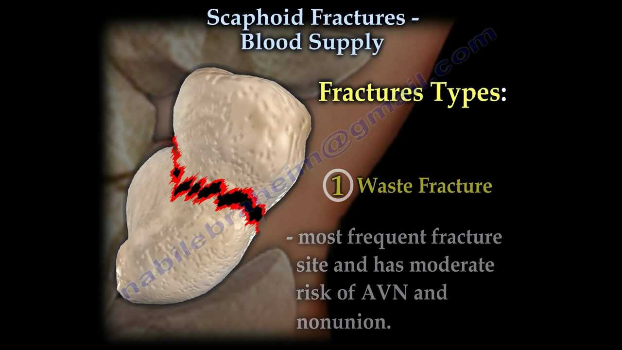 Scaphoid Fractures Blood Supply - Everything You Need To Know - Dr. Nabil Ebraheim