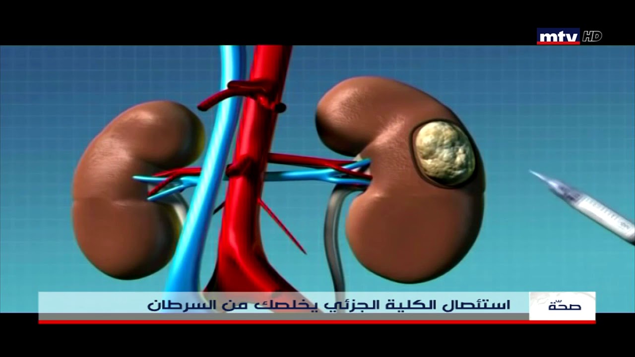Partial Nephrectomy for Treatment of Kidney Tumors