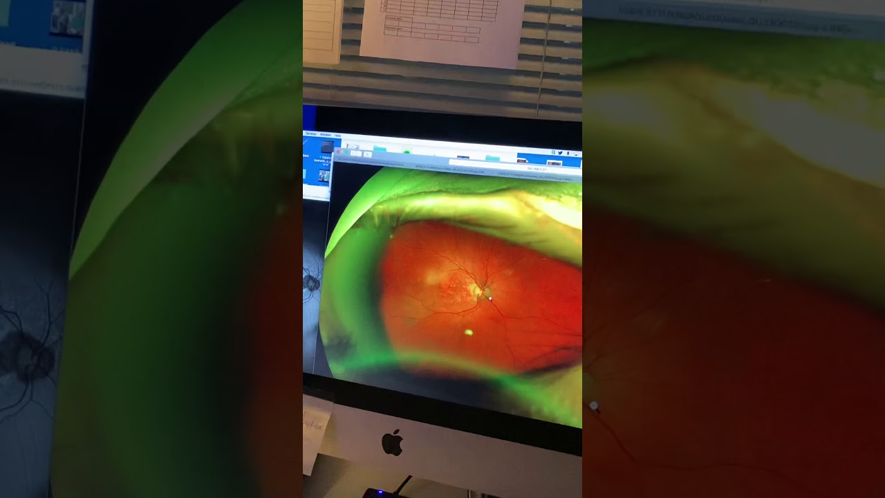 PhotoBioModulation: promising treatment in macular degeneration / retina blindness Kanellopoulos MD
