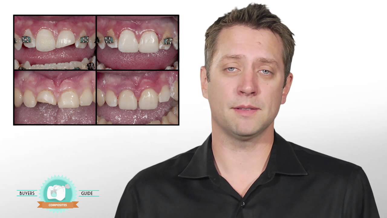 Video Buyers Guide: Dental Composites