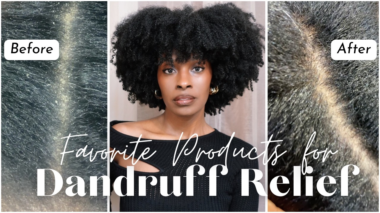Vlogging Like Besties On FaceTime: I GOT DANDRUFF! | My Top 4 Brands, 8 Products To Treat It