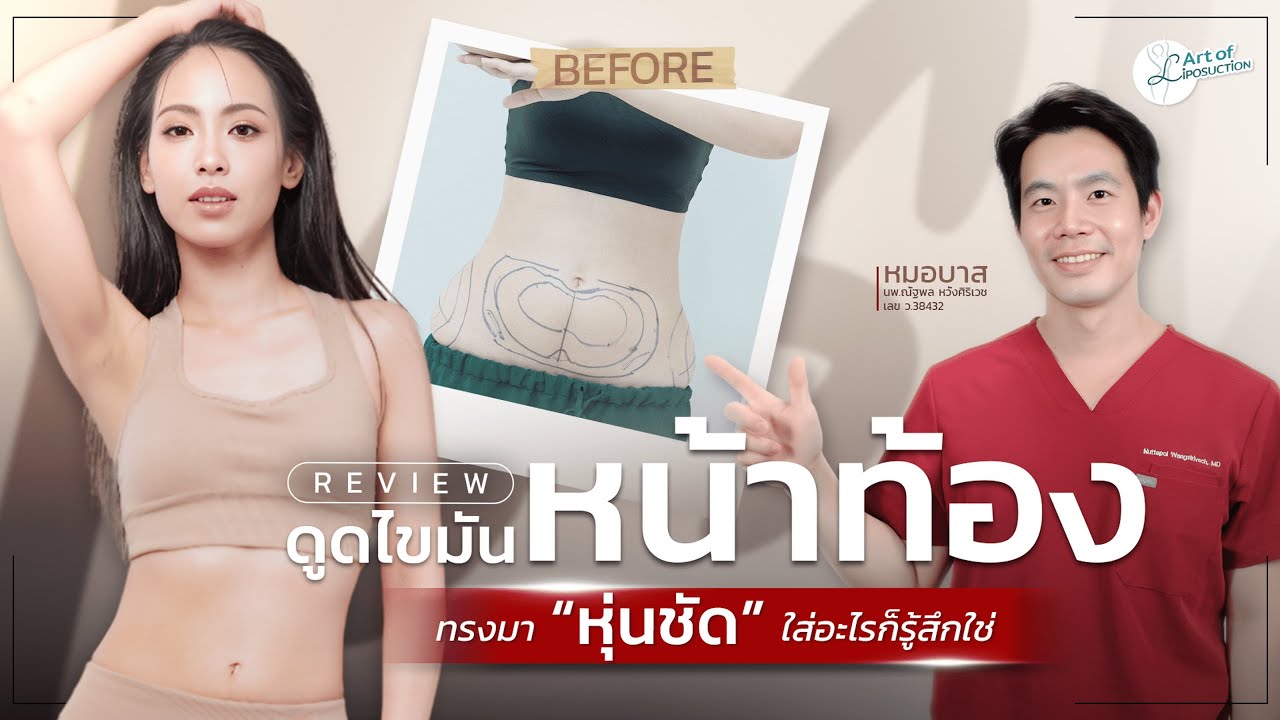 เลิก ! บีบรูป…แล้วแวะมาดูดไขมันที่อิสสวีร์เลย I รีวิวดูดไขมันหน้าท้องกับหมอบาส