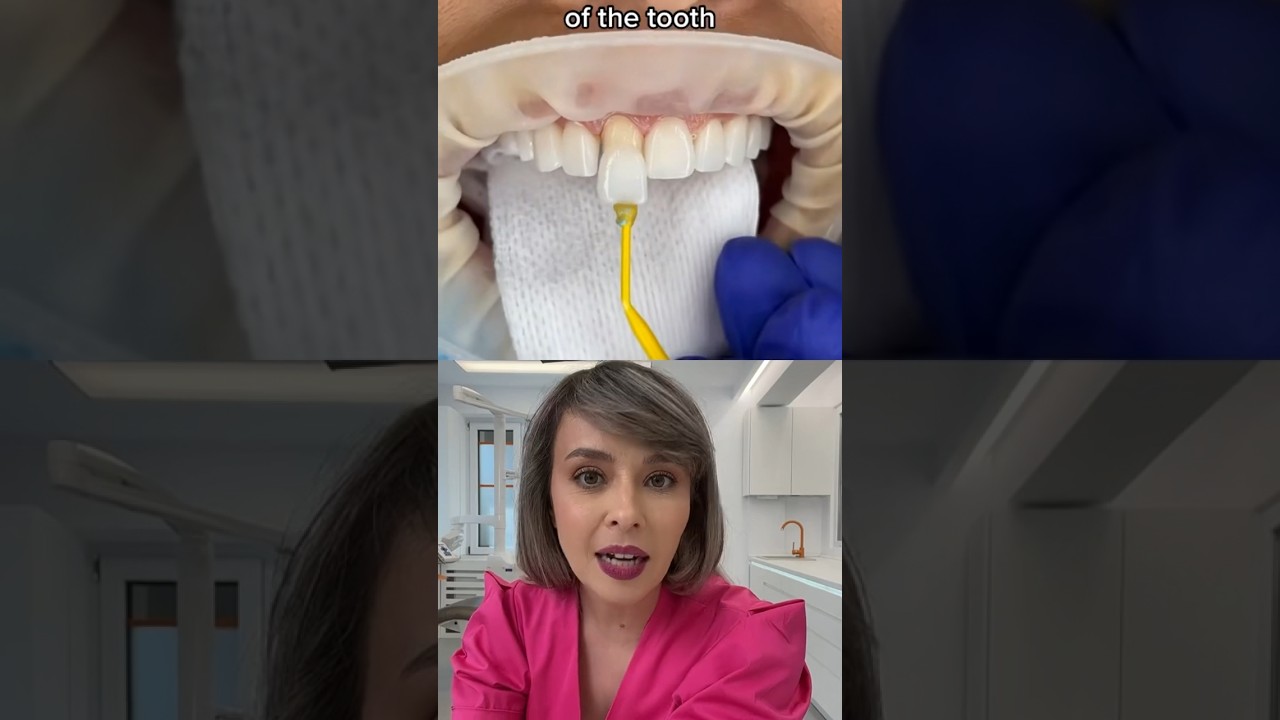 CUM PROBEZI FATETELE DENTARE?