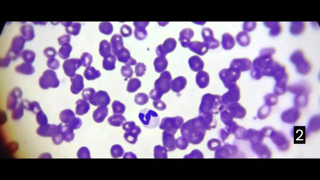 HEMATOLOGÍA (FROTIS Y TINCIÓN)