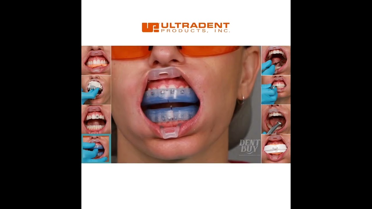 Abreboca umbrella ultradent / usos / ventajas