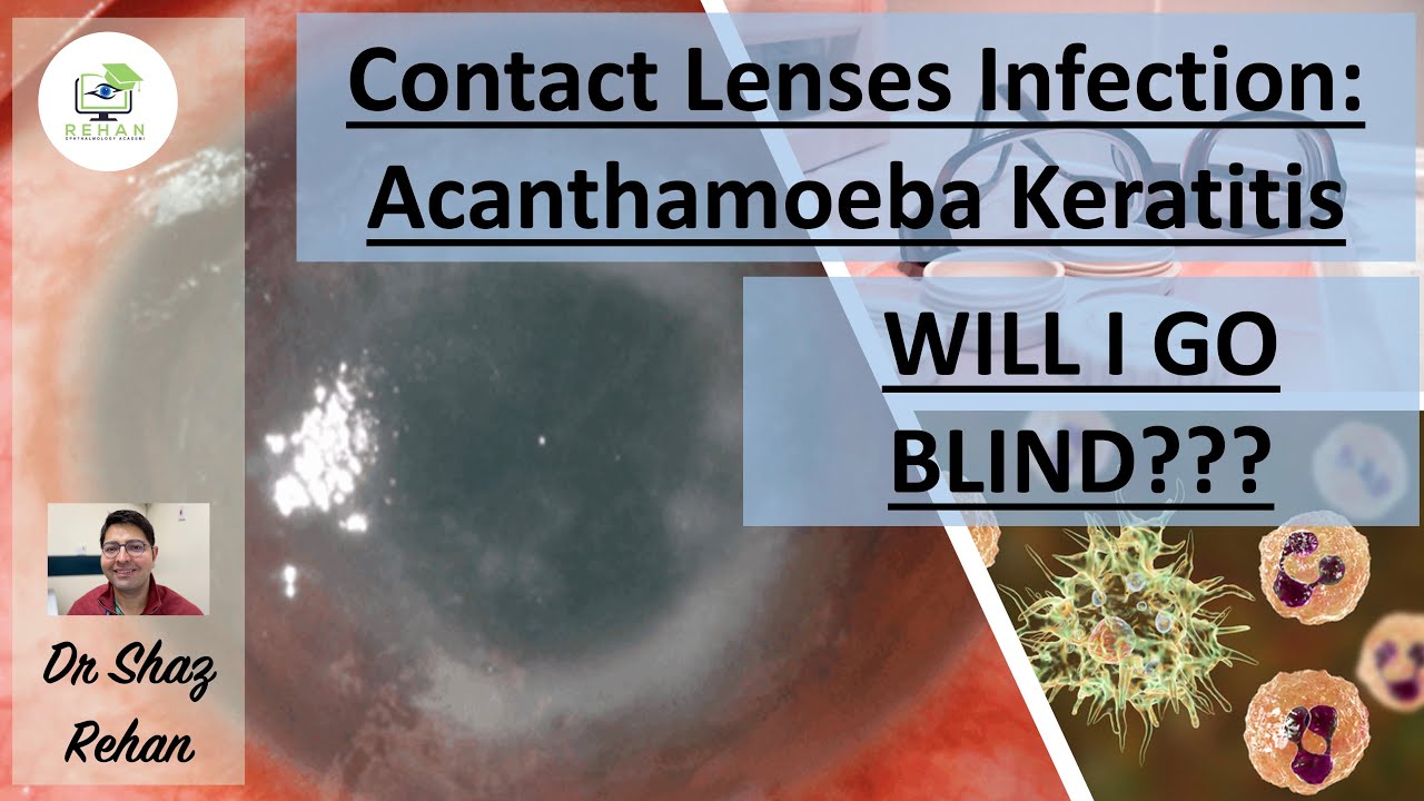 Contact Lenses Related Acanthamoeba Keratitis: Will I Go BLIND? I Dr Shaz Rehan, 2023