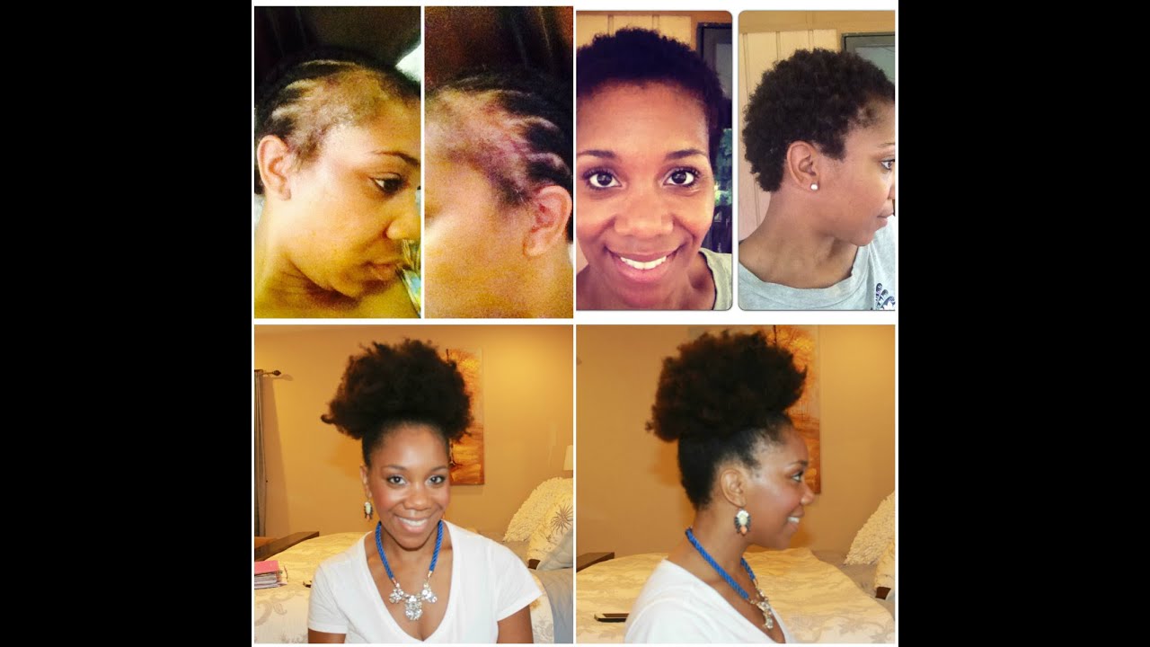 Fight Alopecia Naturally | 10 Steps To Restoration