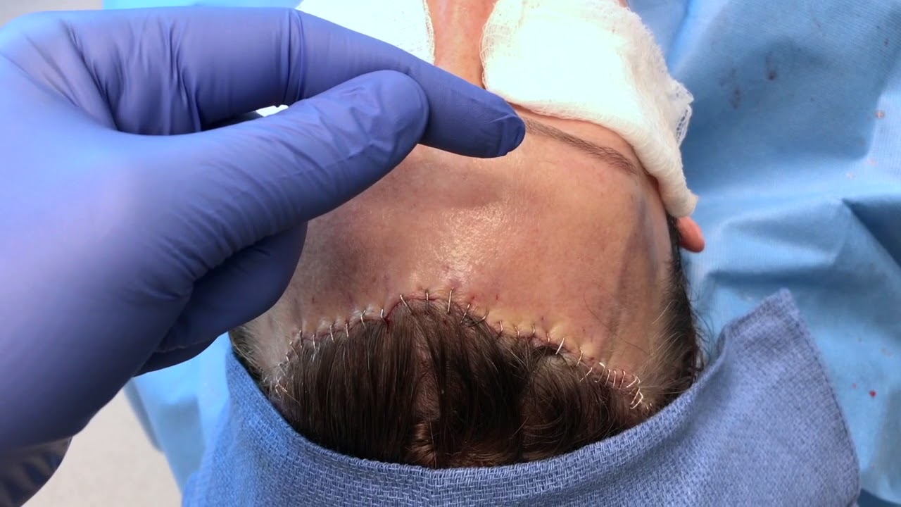 Forehead Reduction with Trichophytic Brow Lift