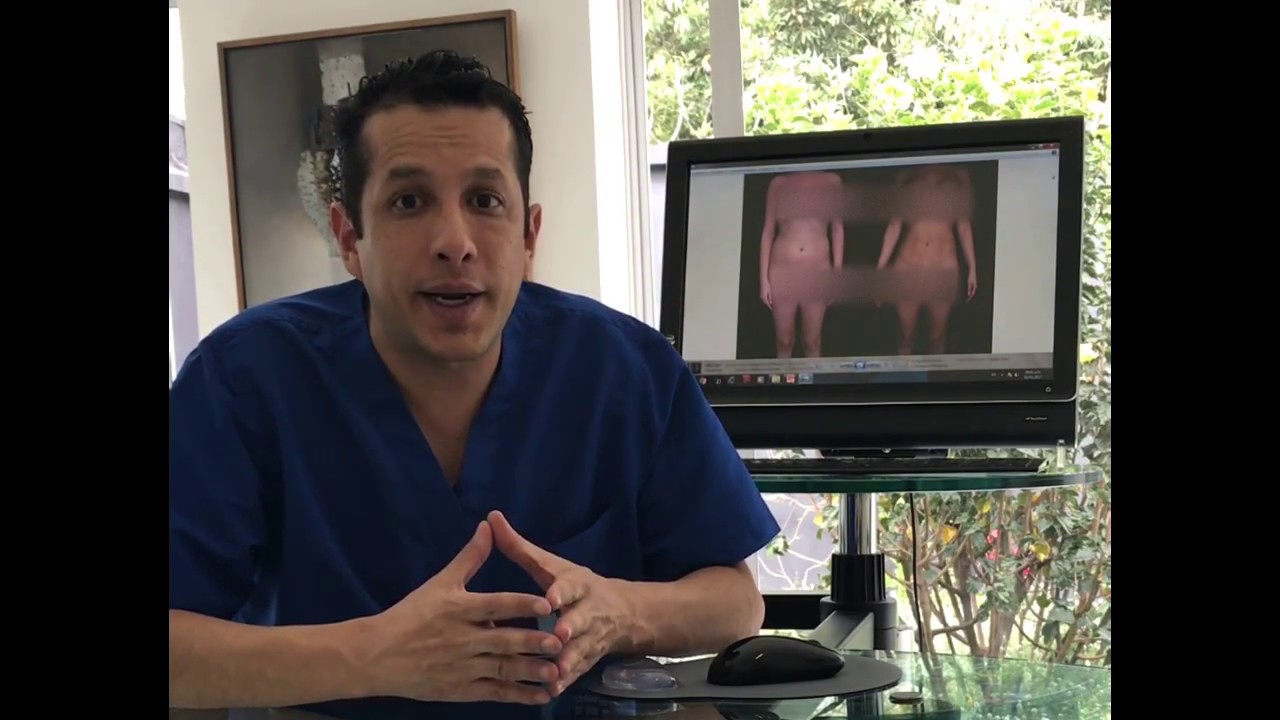 Liposucción | Dr. Ivan Santos - Cirugía plástica en Colombia |
