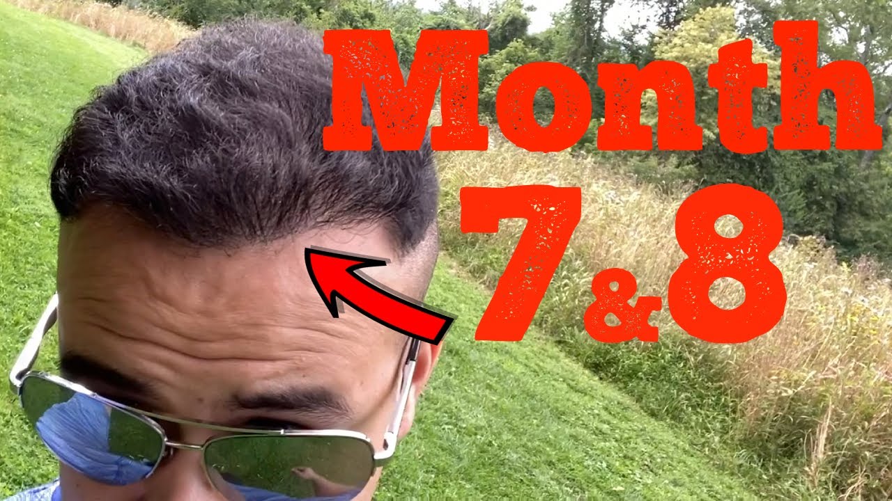 7-8 Months After My FUE Hair Transplant in Turkey | 4,550 Grafts | Cinik Clinic |