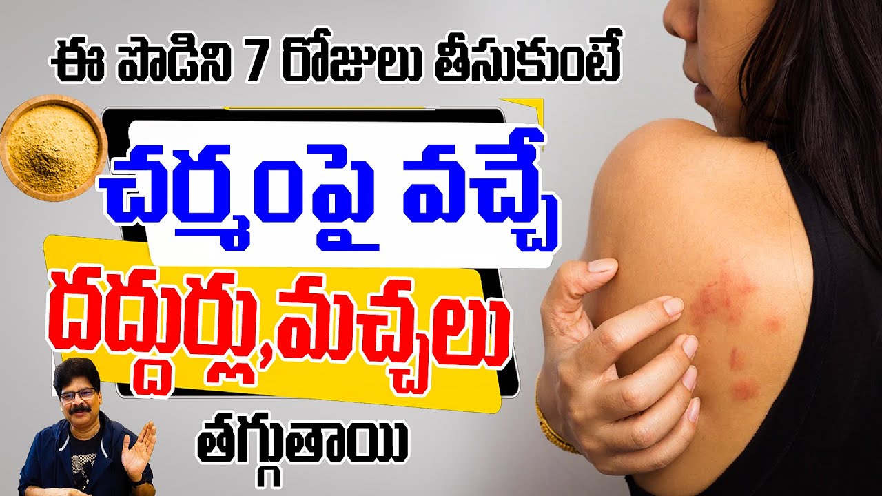 ఈ పొడిని 7 రోజులు తీసుకుంటే చర్మంపై వచ్చే దద్దుర్లు, మచ్చలు తగ్గుతాయి | Reduces Skin Rashes