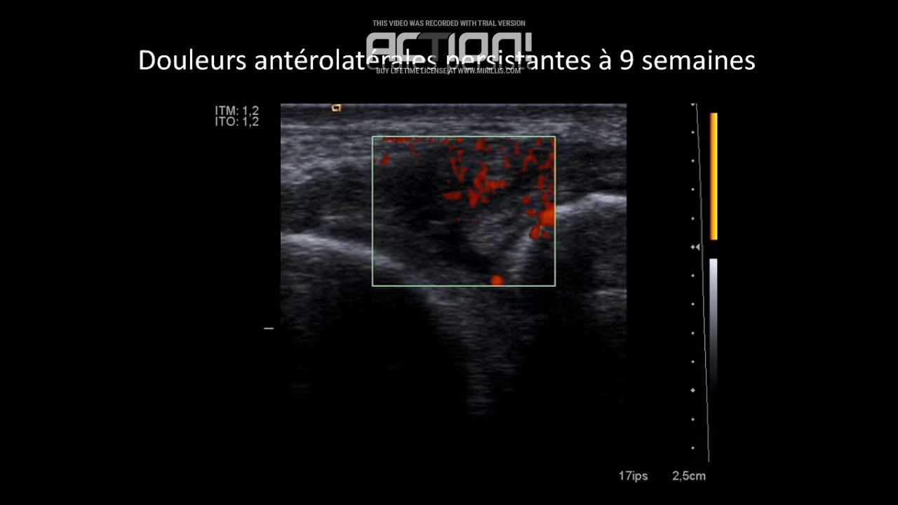 IMAGERIE DES LESIOSN LIGAMENTAIRES ET ARTICULAIRES DE LA CHEVILLE JFR