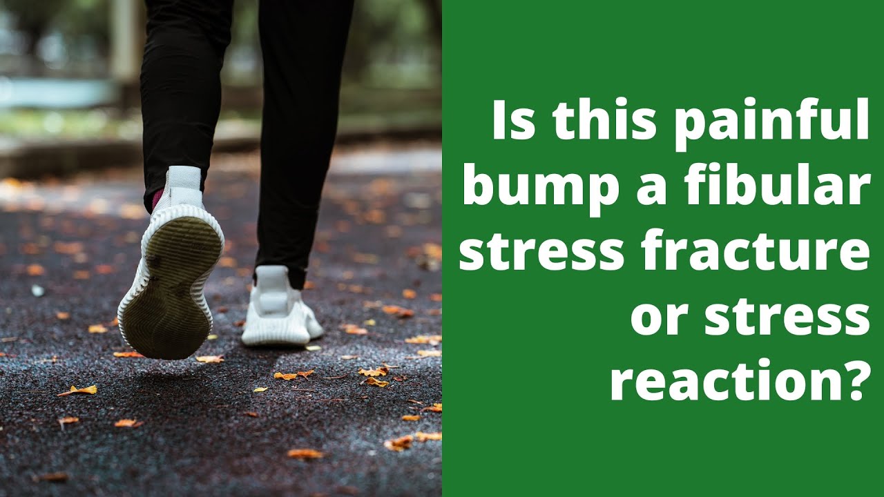 Is this painful bump a fibular stress fracture or stress reaction?
