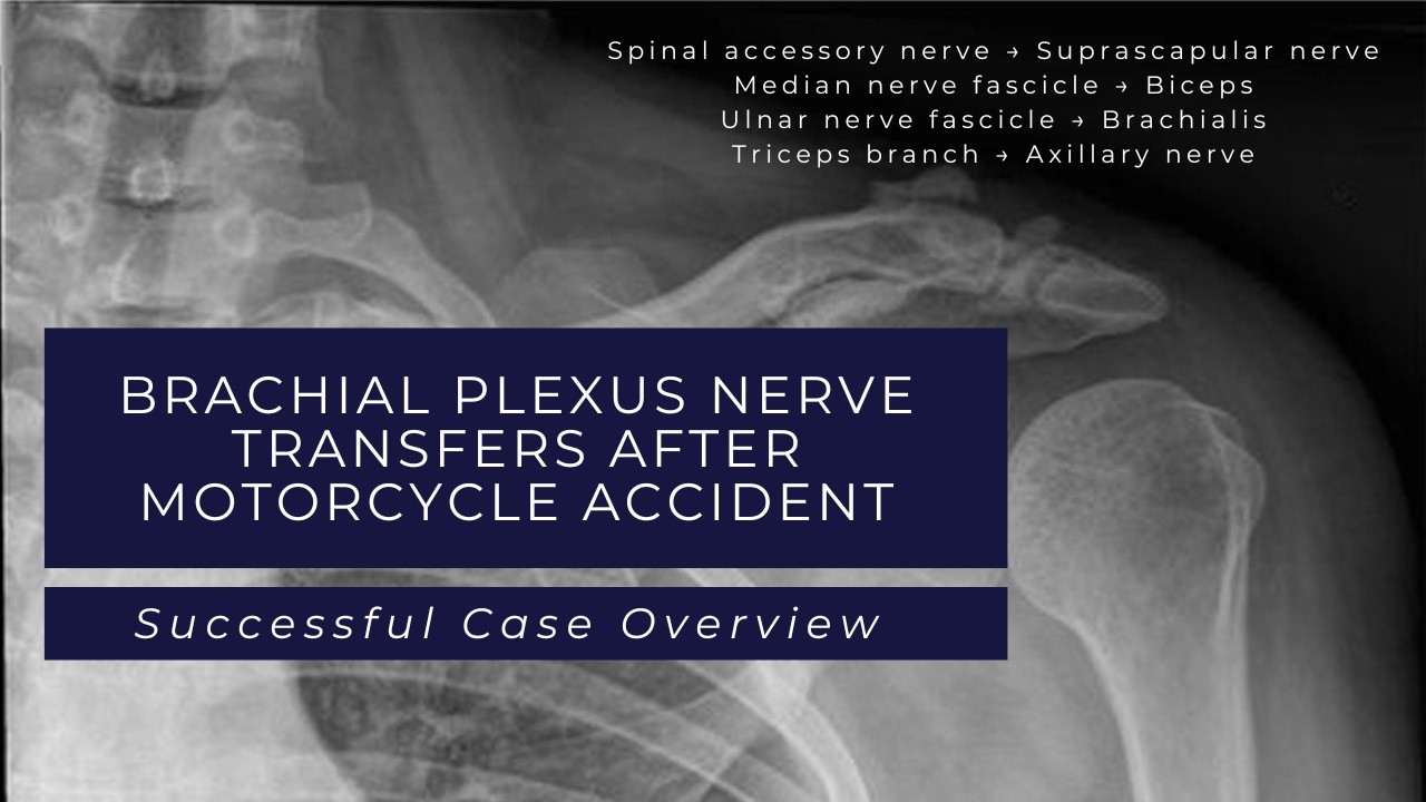 Brachial Plexus Nerve Transfers after Motorcycle Accident | 10-Month Recovery Update