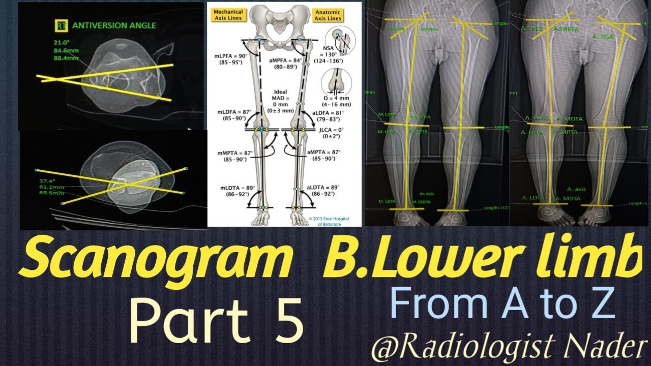 سكانوجرام للطرفين السفليين.الجزء الخامس.زاوية التواء الساقScanogram B.L.L.part5.Tibial Tortion Angle