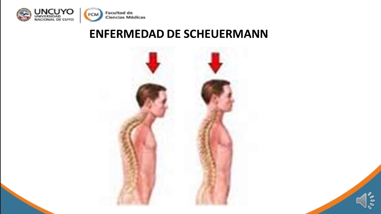 OSTEOCONDRONECROSIS  SEGUNDA PARTE 1