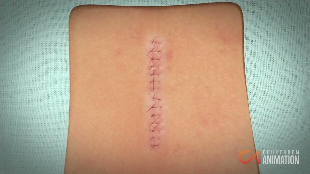 Removing Herniated Disk (Surgery Animation)