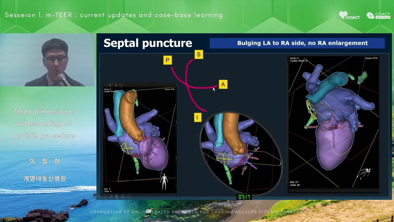 HALLA 2025 CJV 1-4 : Case based learning : 3D understanding of M-TEER procedure 이철현