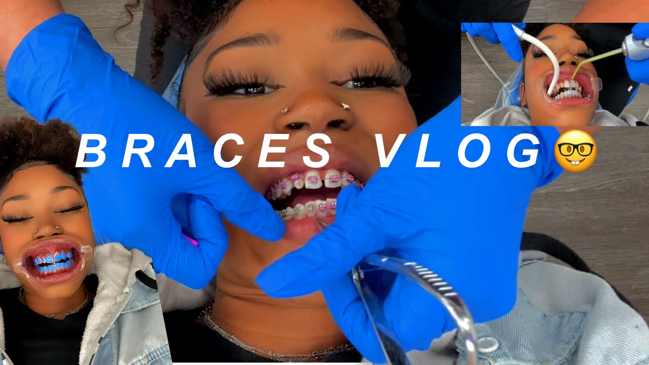 Braces Vlog 🤓 | N’finidii