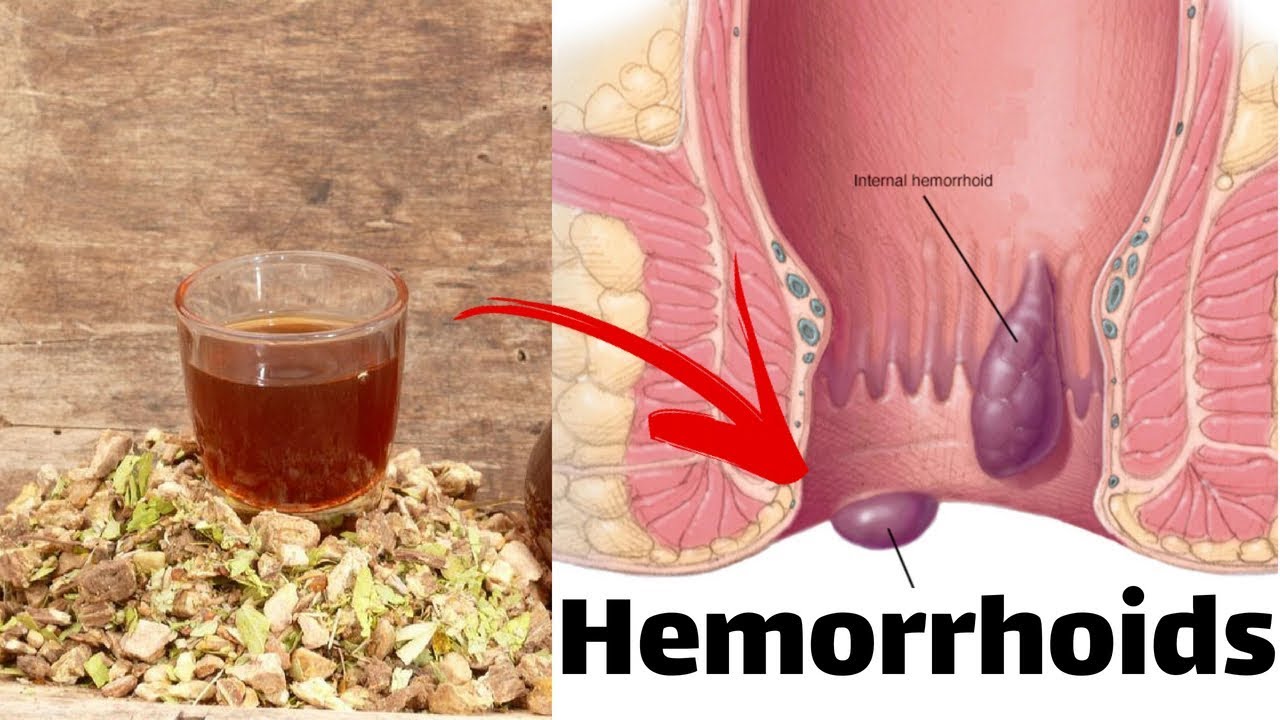 How To Get Rid Of Hemorrhoids with Swedish Bitter?  - Get Rid Of Hemorrhoids Naturally