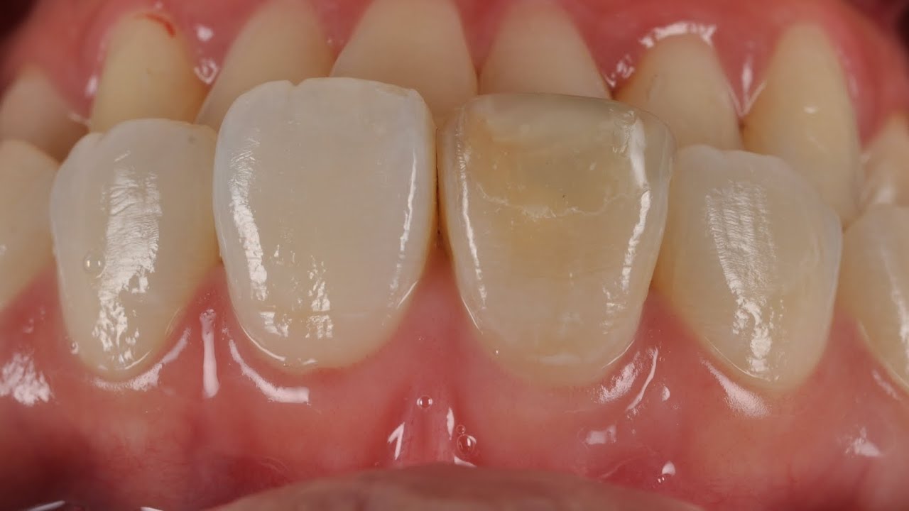 Treatment for dark tooth. (step by step internal bleaching)