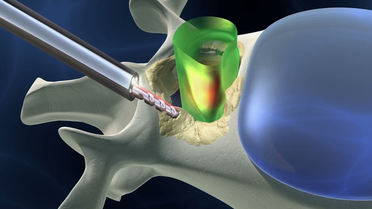 Endoscopic spinal surgery with voiceover narration