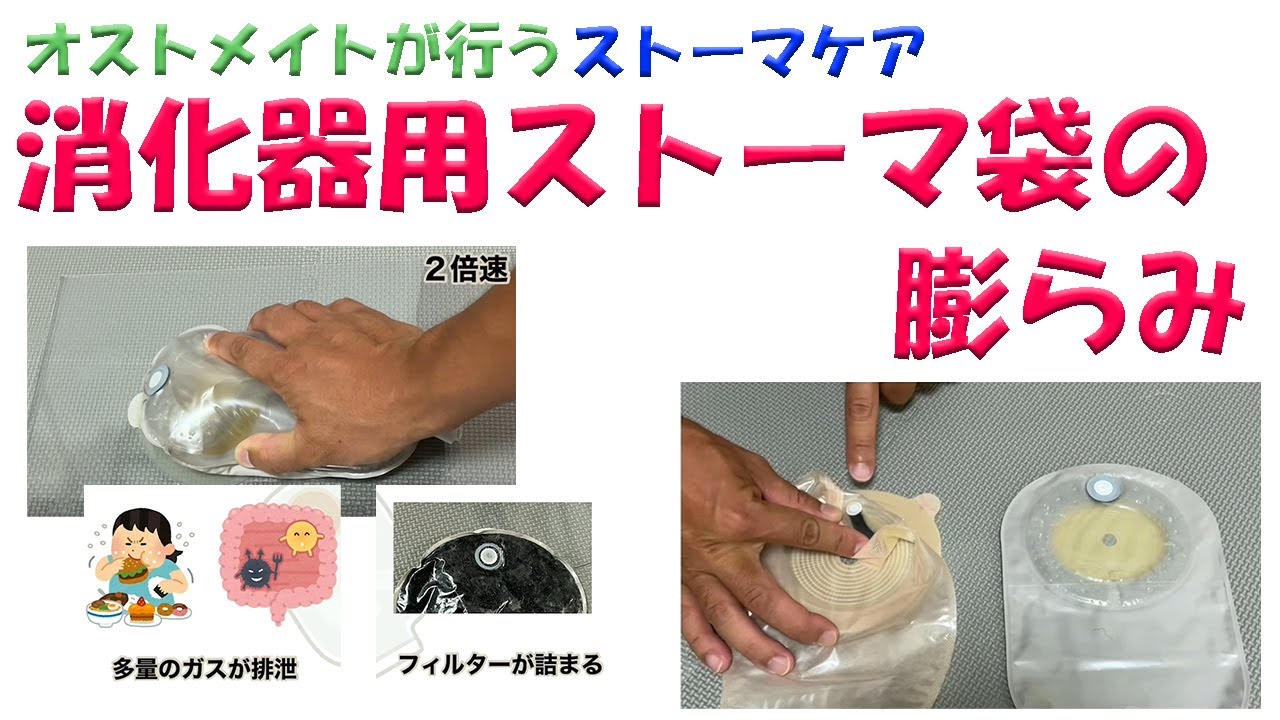 【オストメイトの生活関連】消化器用ストーマ袋の膨らみ
