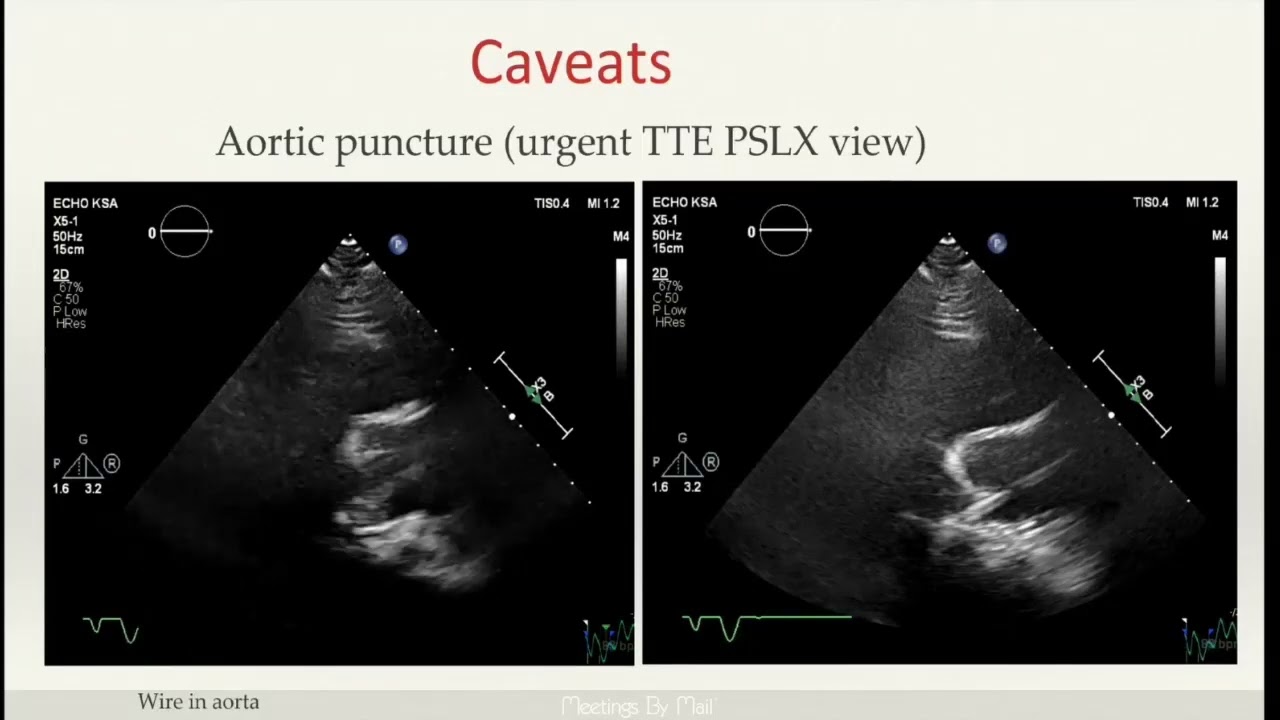 Пошаговое руководство по проведению трансэзофагеальной эхокардиографии для оценки трансэзофагеаль...