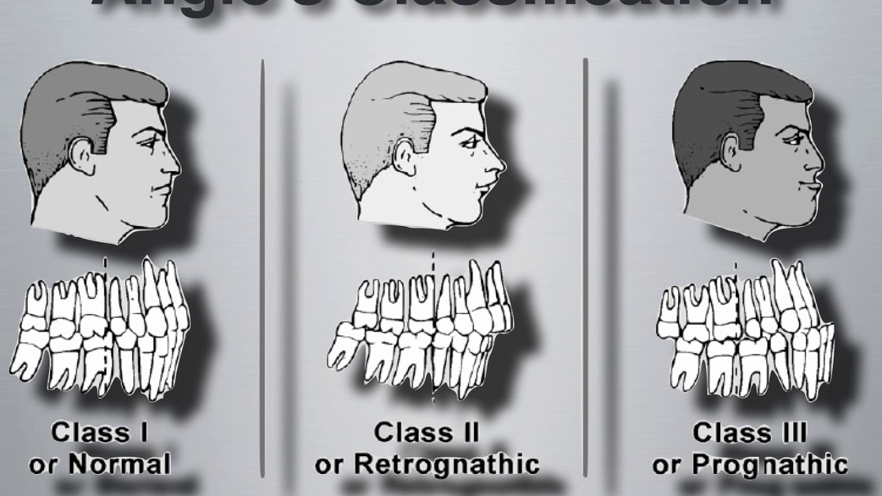 Complete Dentures 1 - 6) Angle's Classification System