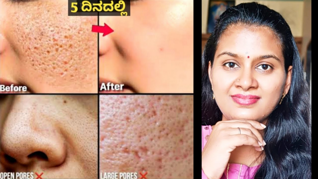 ಎಷ್ಟೇ ಹಳೆಯ OPEN PORES, LARGE PORES, CLOGGED PORES ಇರಲಿ, ಈ Remedy ಯಿಂದ 100% ಗುಣ ಆಗುತ್ತೆ