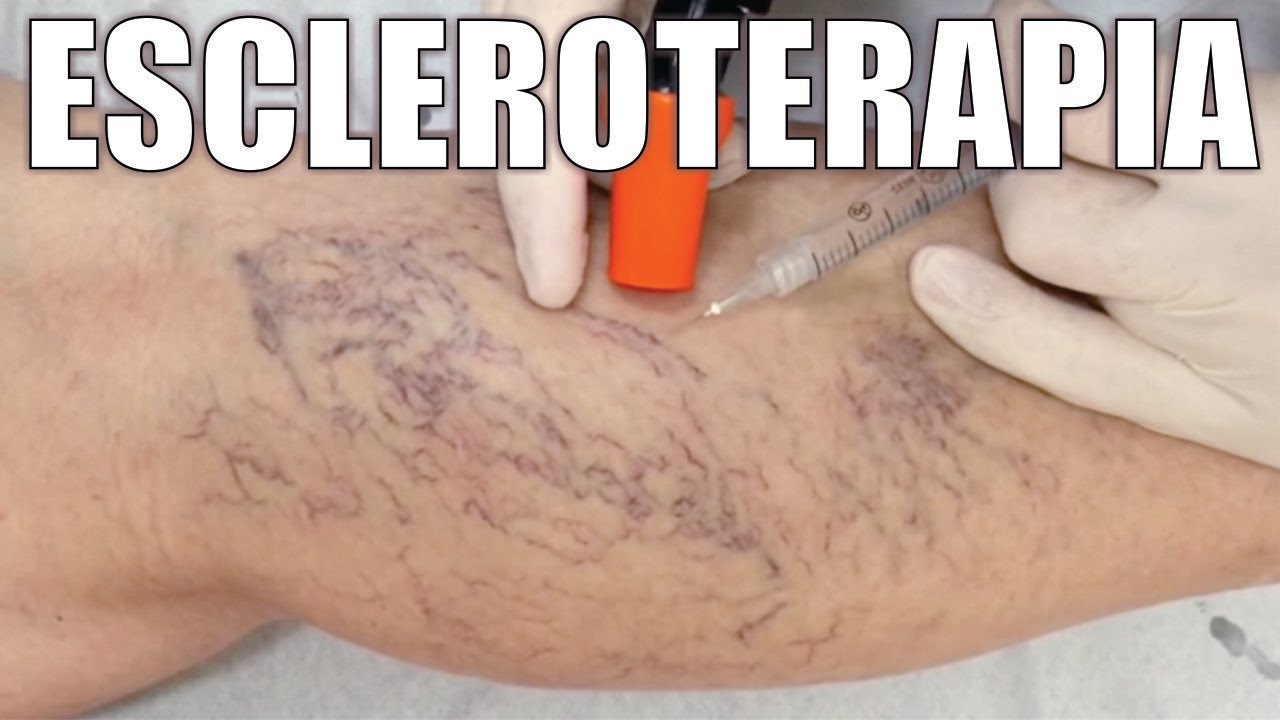 ESCLEROTERAPIA con ESPUMA para VÁRICES y ARAÑITAS VASCULARES 💉🦵🏻 Dr IVAN GUTIÉRREZ ⭐ FLEBOCENTER