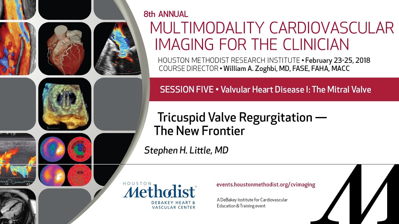 Tricuspid Valve Regurgitation — The New Frontier (STEPHEN H. LITTLE, MD)