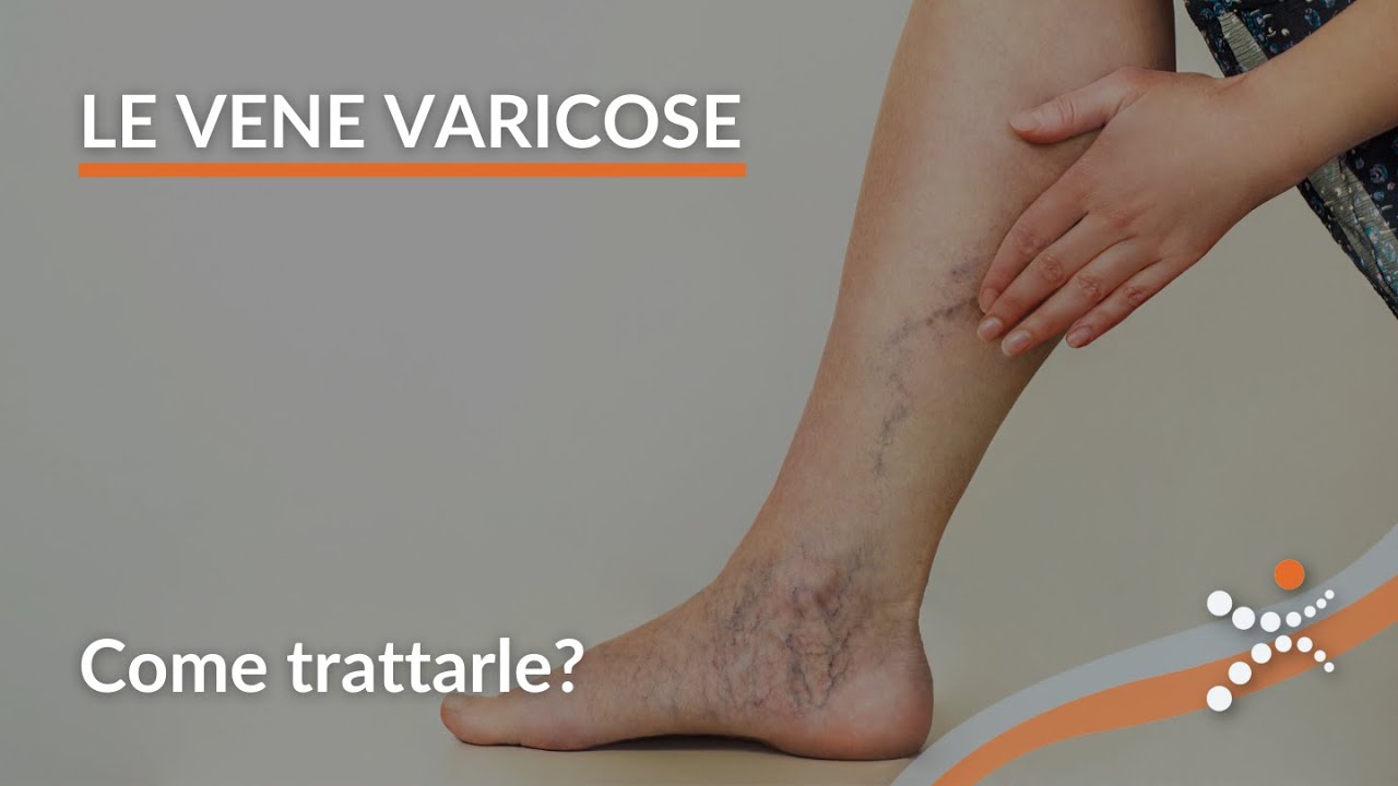 Vene Varicose: Cause, Consequenze e Trattamenti | Tutto Quello Che Devi Sapere