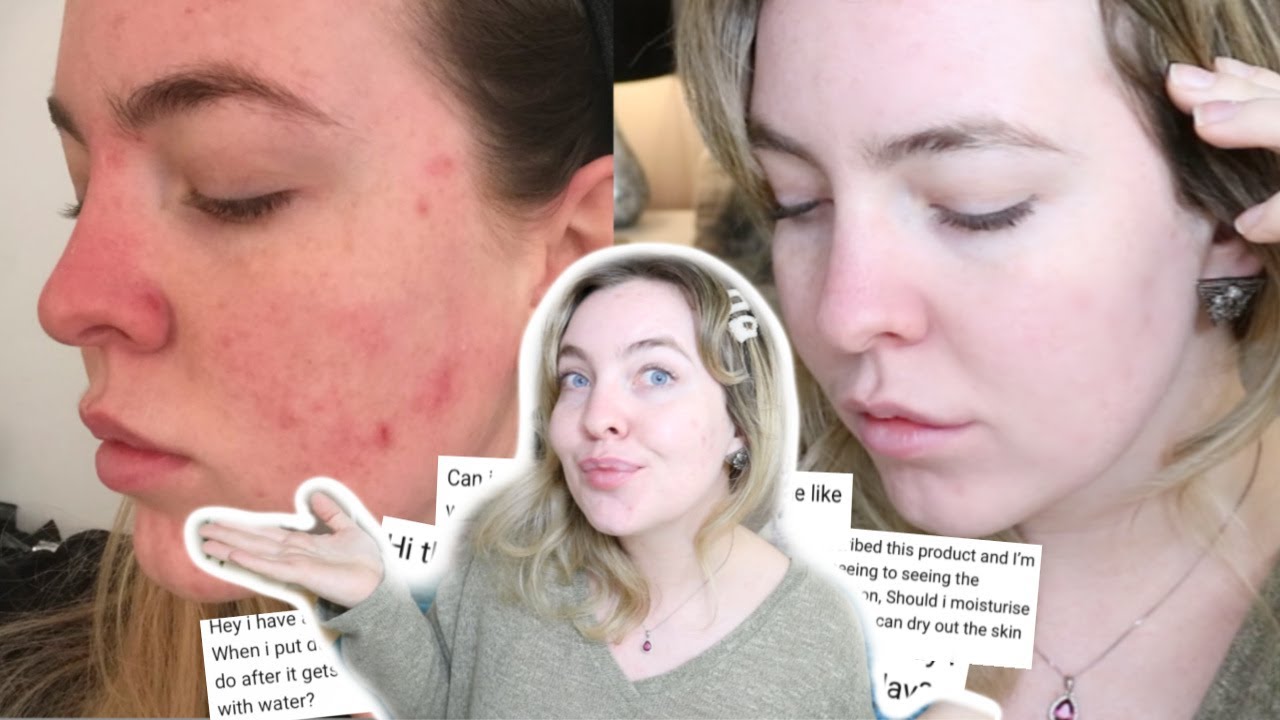 MY ACNE JOURNEY 1 YEAR LATER, HOW DUAC SAVED MY SKIN | ANSWERING YOUR QUESTIONS