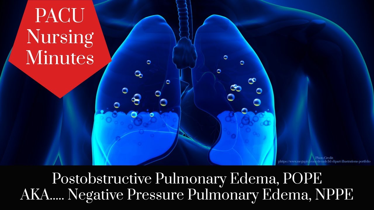 Postobstructive Pulmonary Edema, POPE AKA....Negative Pressure Pulmonary Edema, NPPE, PACU Nursing.